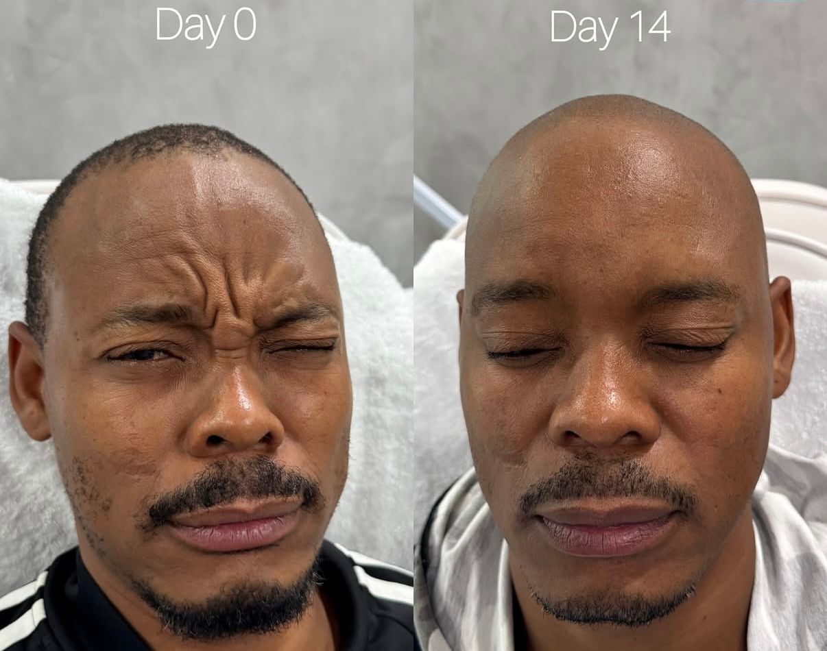 Lip Enhancement